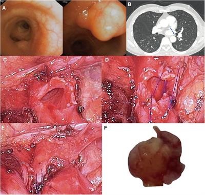 Tracheal or bronchial wedge resection: Case report
